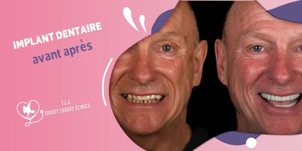 Implant dentaire avant après 