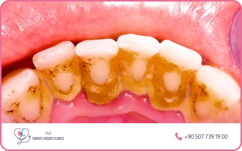 شكل جير الاسنان