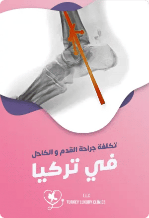 تكلفة جراحة القدم والكاحل في تركياfeatured image