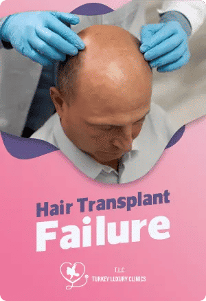 Haartransplantation fehlgeschlagen