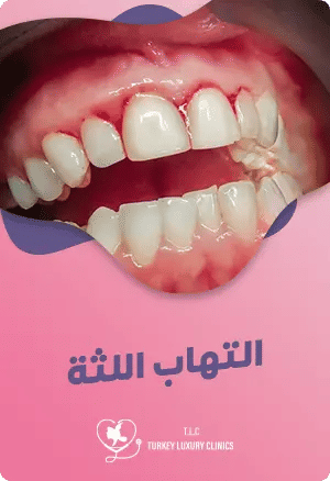 التهاب اللثة: الأسباب، الأعراض، وأفضل الطرق للوقاية والعلاجfeatured image