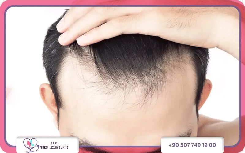 علاج فراغات الشعر: أفضل الطرق الطبيعية والدوائية-1772049183375