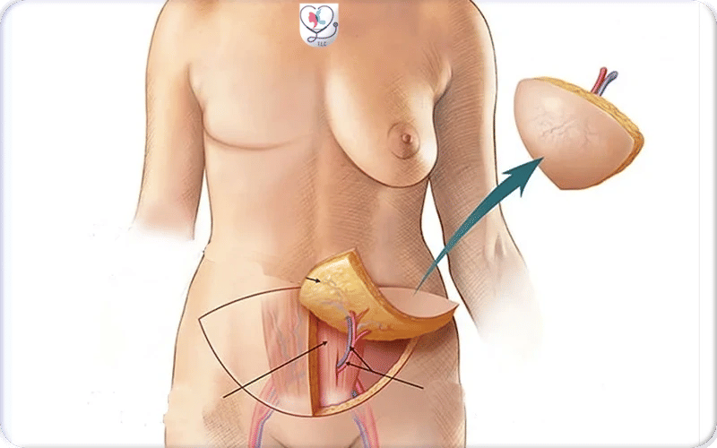 Reconstruction autologue