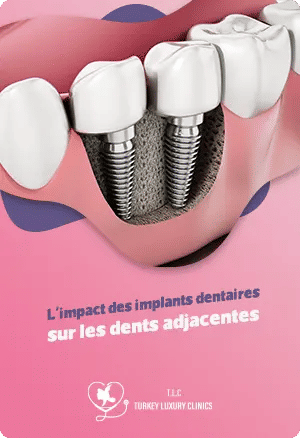 L'impact des implants dentaires sur les dents adjacentes