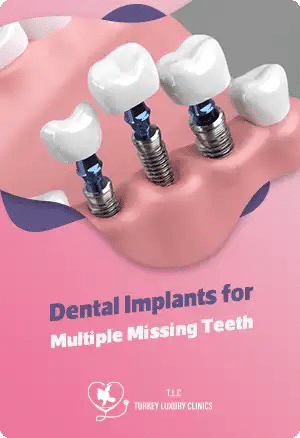 Dental Implants for Multiple Missing Teeth: What to Expect?