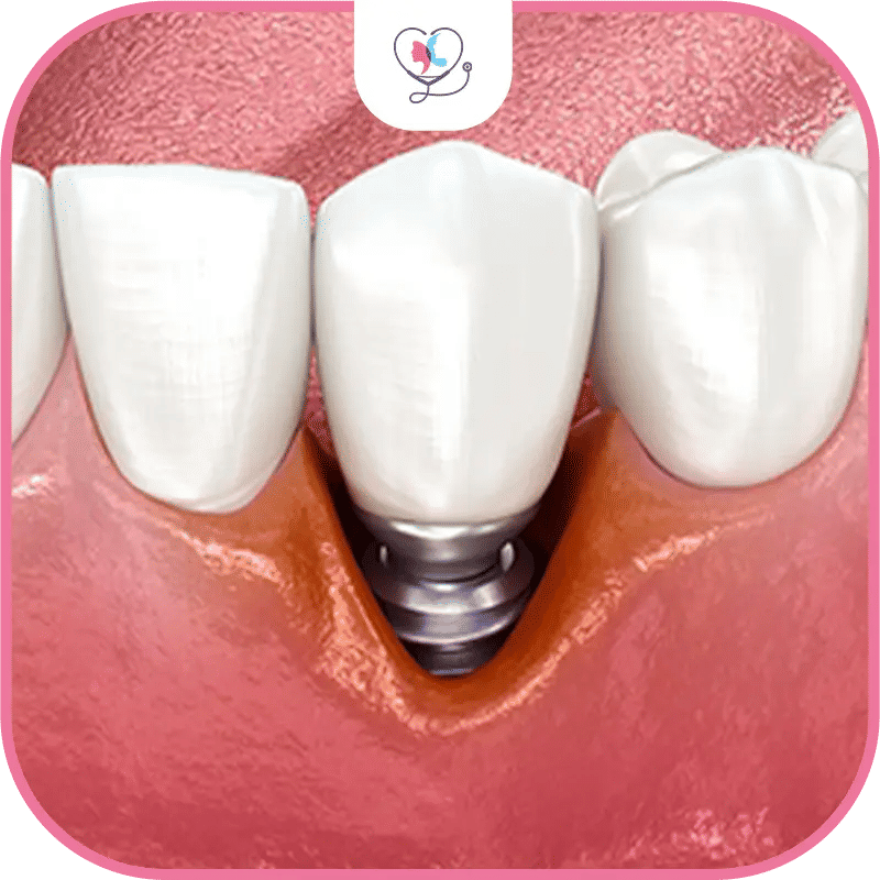 Préservation des dents adjacentes