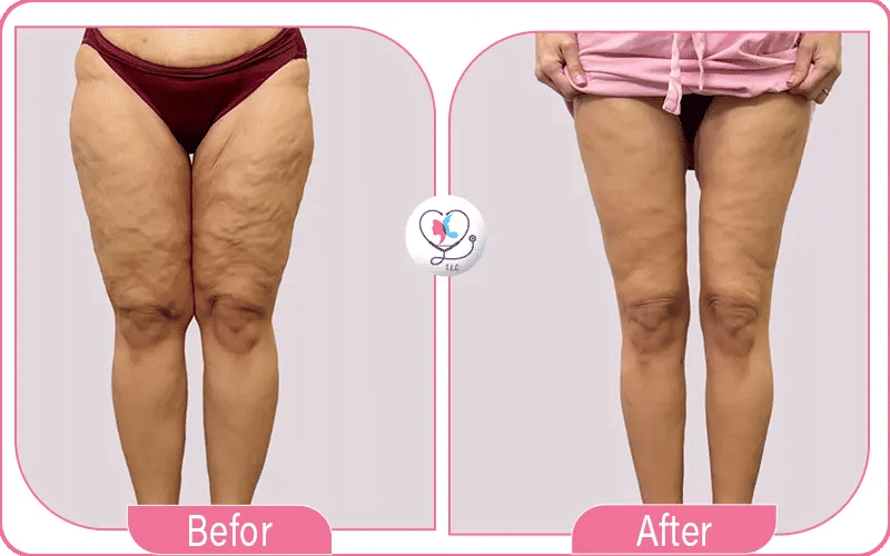 المعاناة مع الترهل بعد التكميم