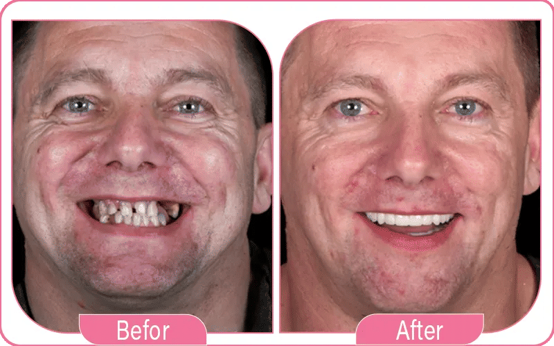 Front Tooth Implant Procedure