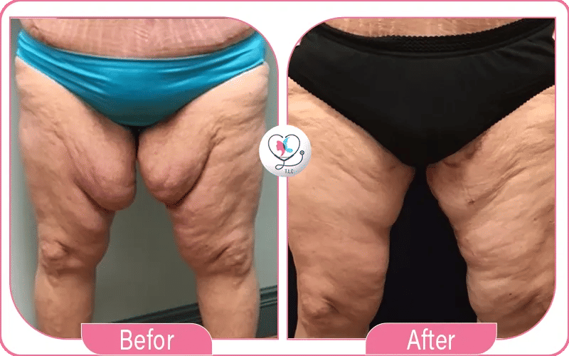 تجربتي في عملية شد ترهلات الفخذين