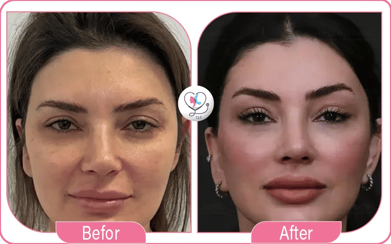 تجربتي مع رفع الحواجب بالليزر