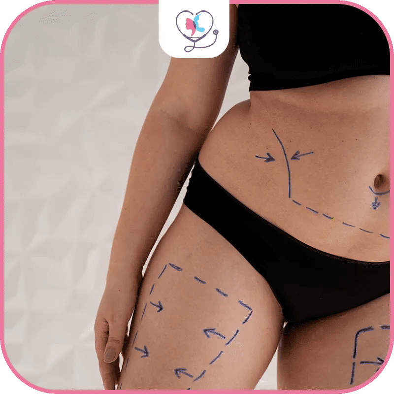 lipofilling prix - tarif lipofilling - lipofilling visage prix - prix lipofilling