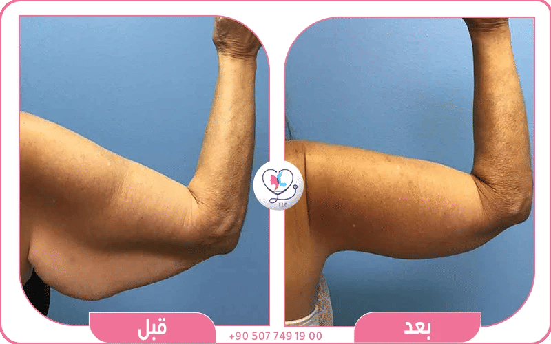 عملية شد الزنود