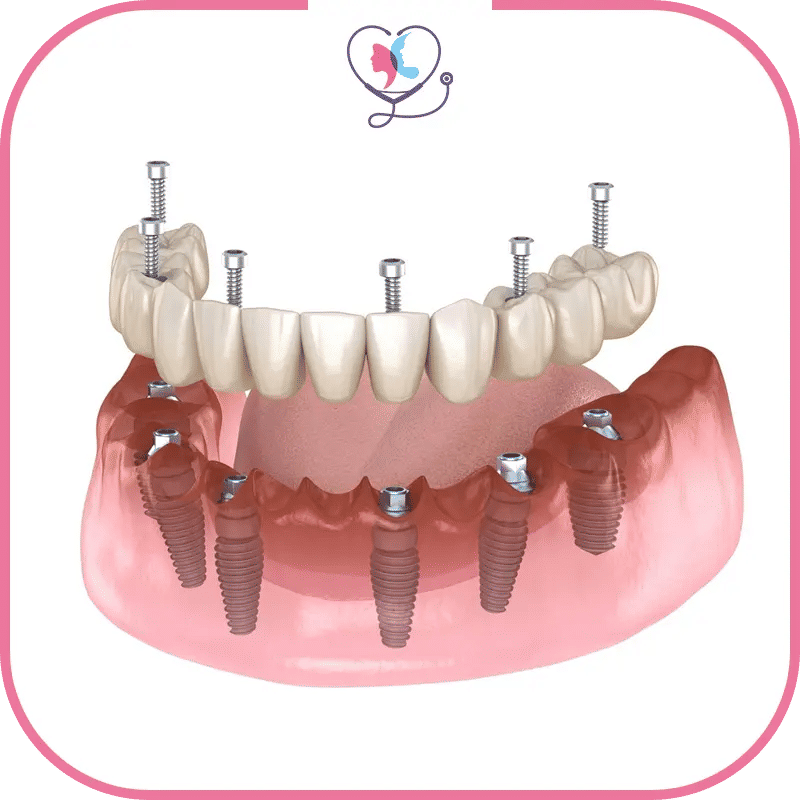 ما هي زراعة الأسنان all-on-6؟