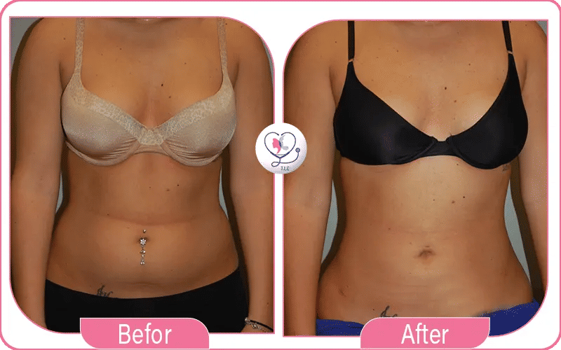 أهم النصائح من تجربتي مع عملية شد البطن والصدر