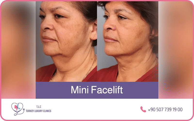 Mini lifting facciale in Turchia prima e dopo – ringiovanimento mirato della parte inferiore del viso e della linea della mascella presso Turkey Luxury Clinics Istanbul