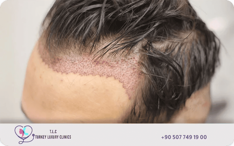 هل يمكن زراعة الشعر بدون حلاقة؟ هل يمكن زراعة الشعر بدون حلاقة؟