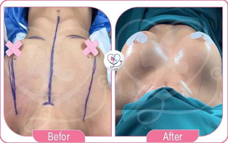 Lollipop Breast Reduction Results