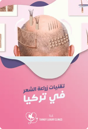 ماهي تقنيات زراعة الشعر في تركيا؟featured image