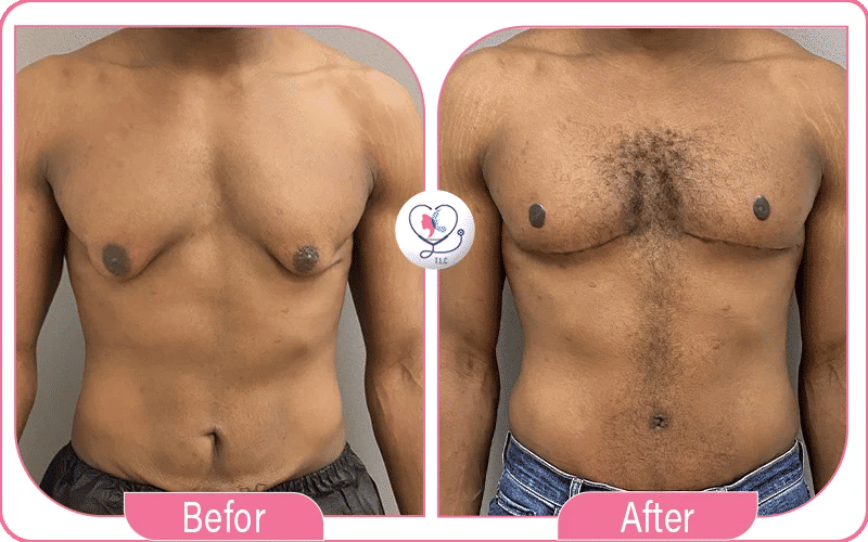 Male 360 Lipo with Gynecomastia Before and After