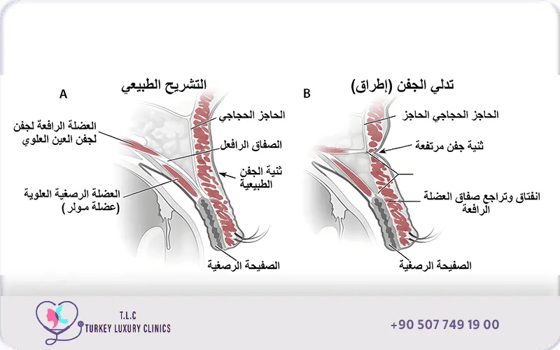 عملية ارتخاء الجفن