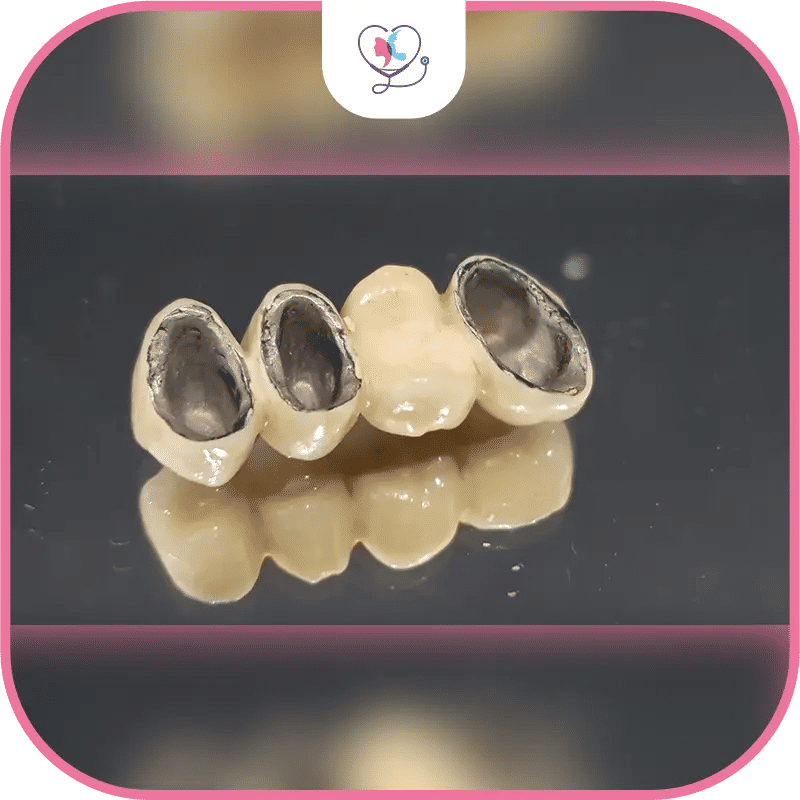 Avantages du bridge dentaire métallique