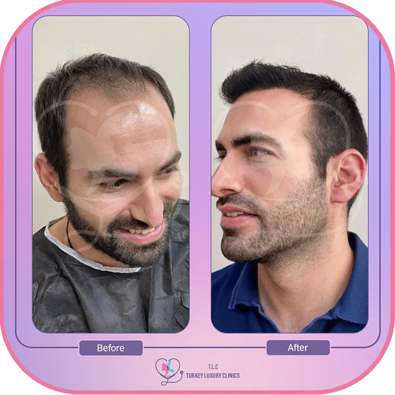 DHI Hair Transplant Turkey 2025: Prices, Results & What to Expect 