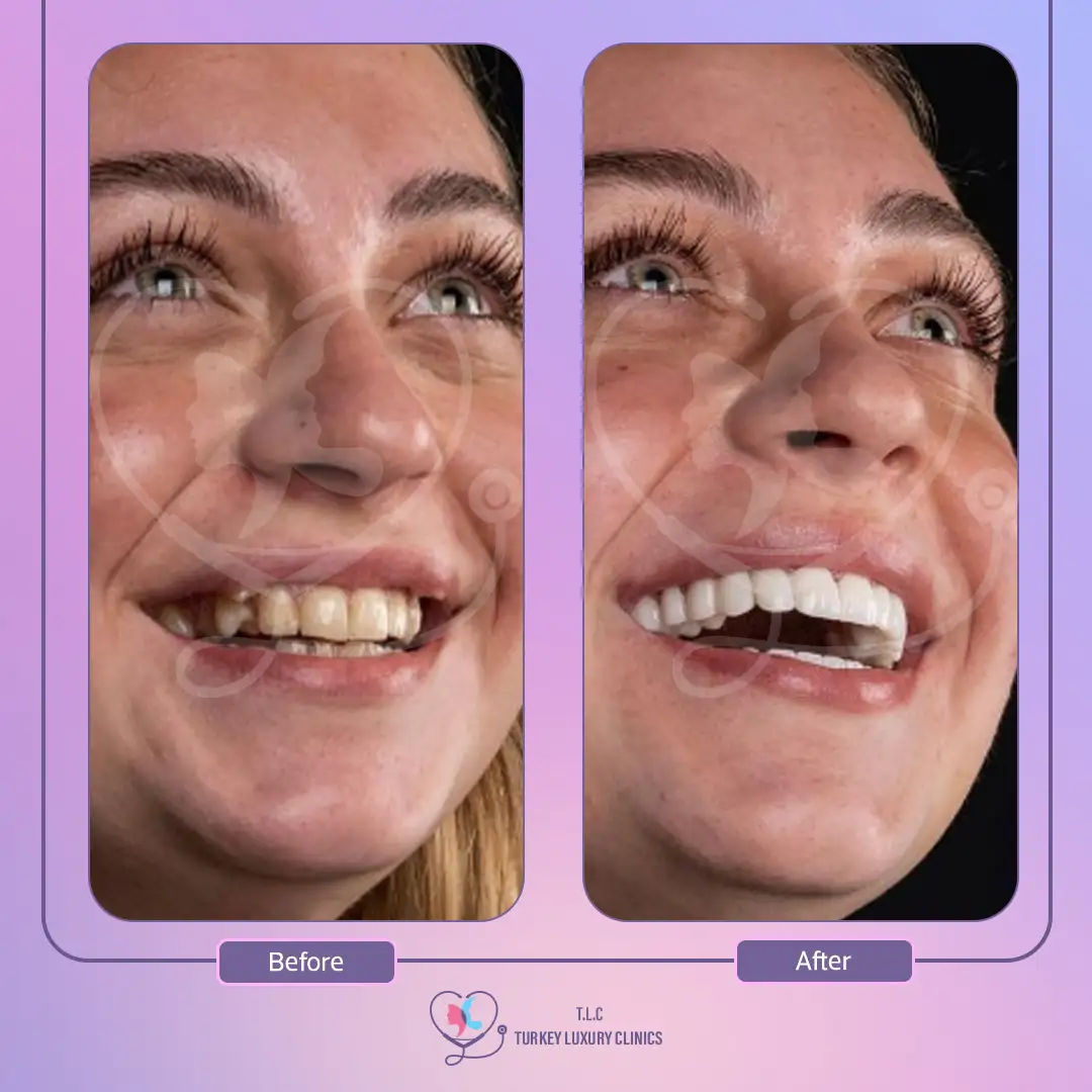 facette turquie avant après - facette turquie istanbul prix - facette dentaire prix turquie