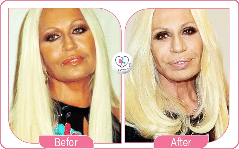 chirurgie plastique ratée photos