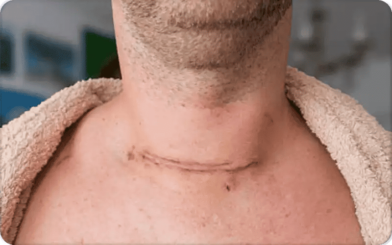 ما بعد علاج سرطان الغدة الدرقية 