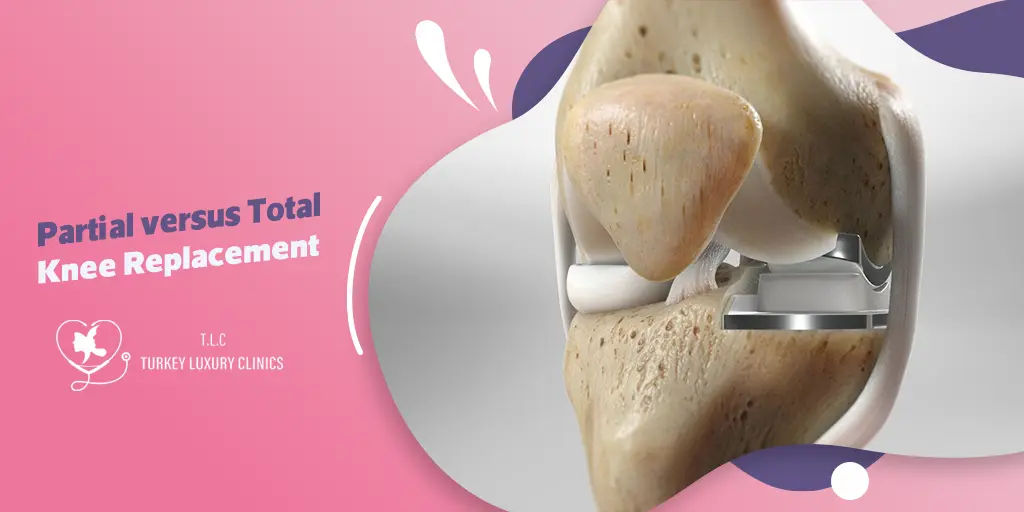 Partial versus Total Knee Replacement: Which is Better for You?