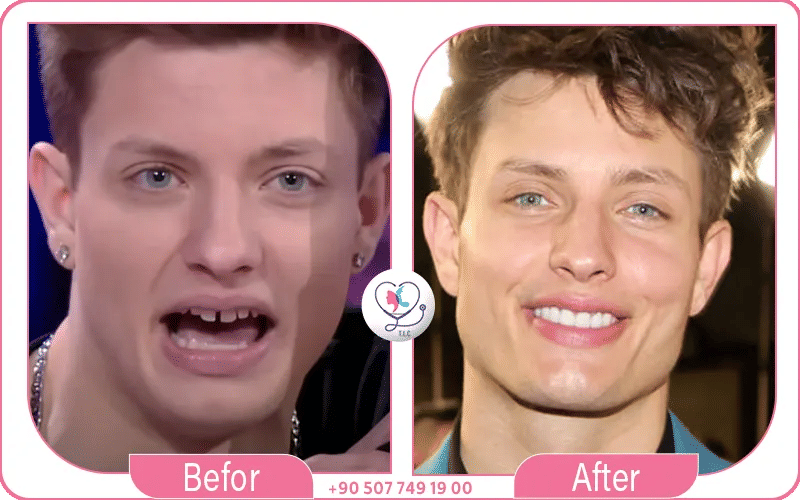 Matt Rife Veneers