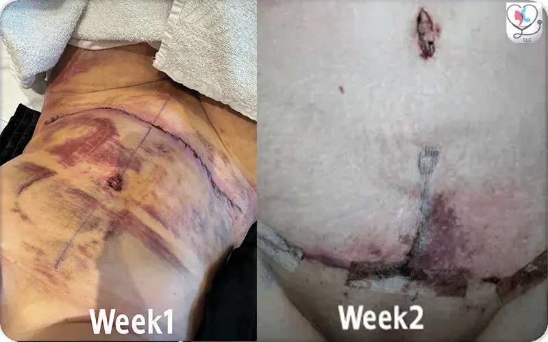 Week 1 of Belly Button After Tummy Tuck