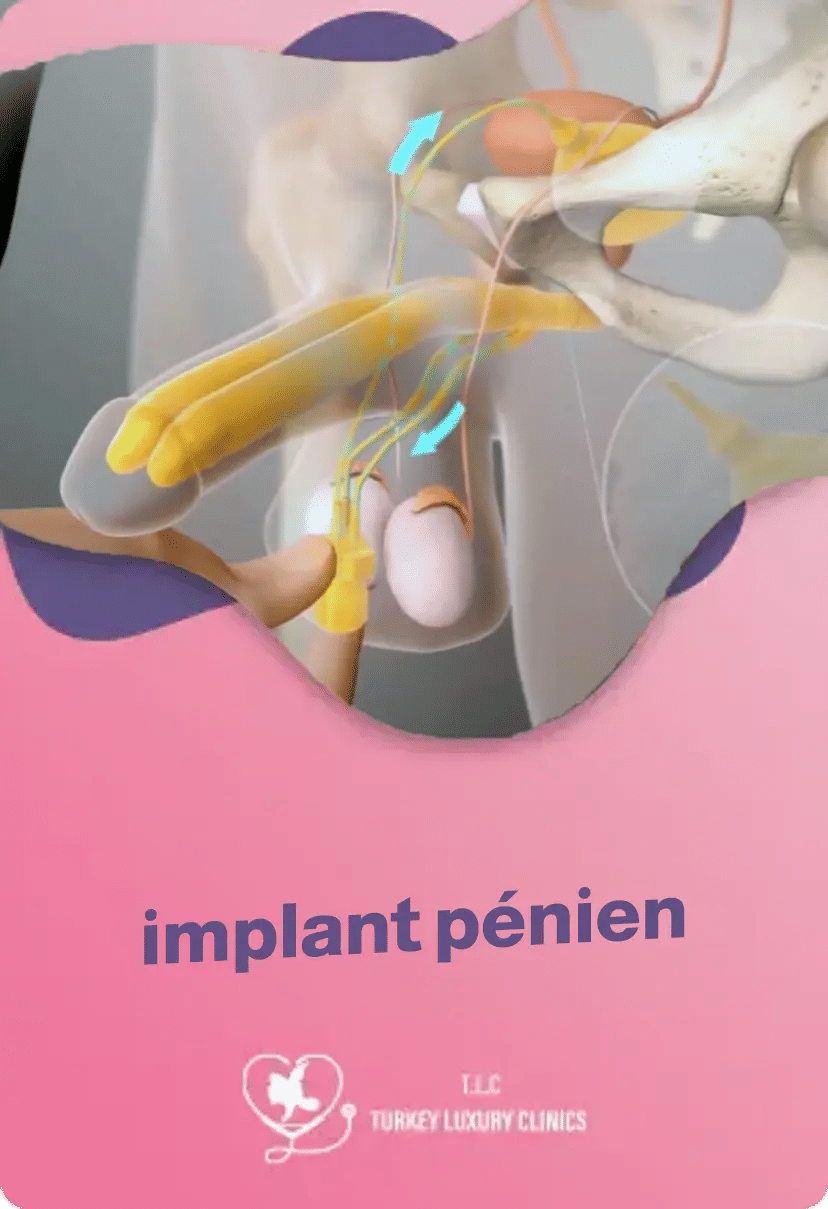 Implant pénien : types, prix, avantages et témoignagesfeatured image