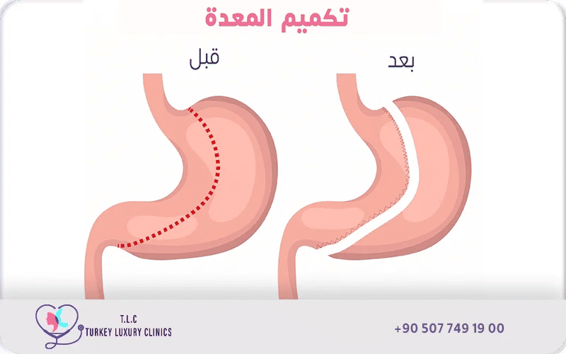 صورة توضيحية لتشريح المعدة قبل العملية