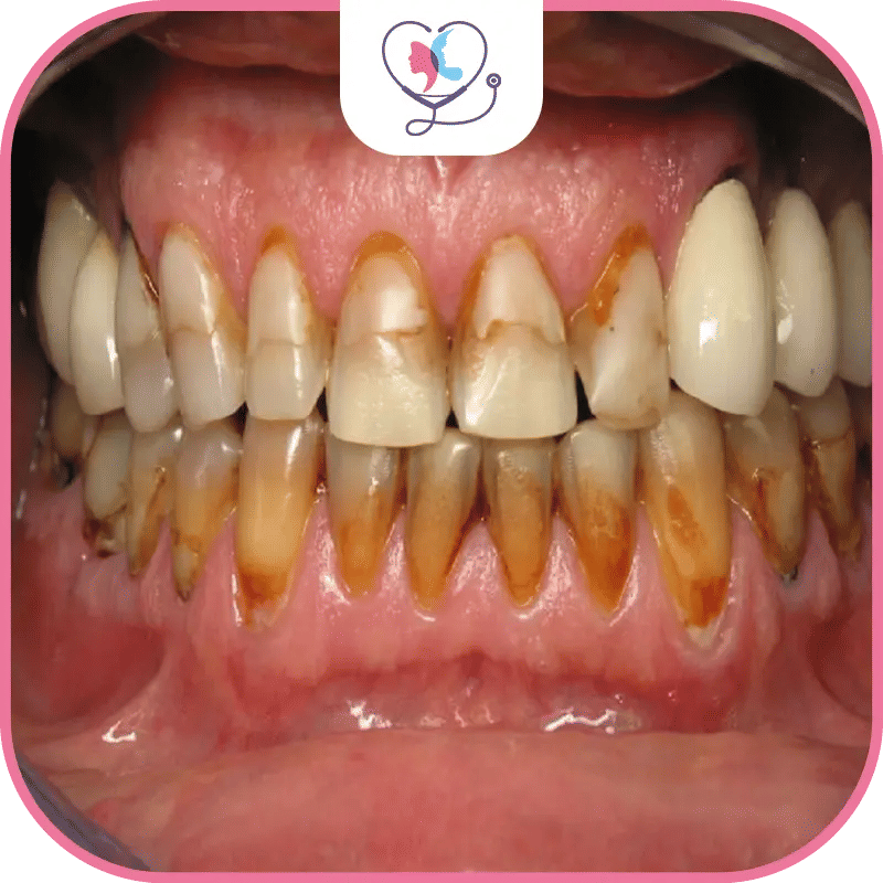 ما هي تصبغات الأسنان؟