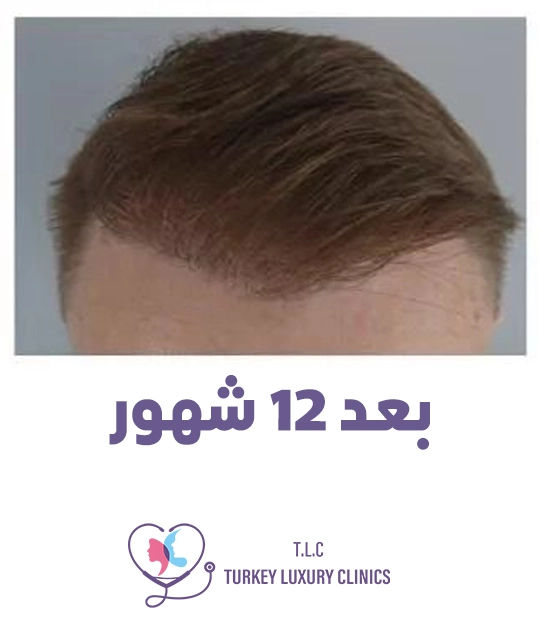 مرحلة نمو الشعر الكامل (6-12 شهراً)