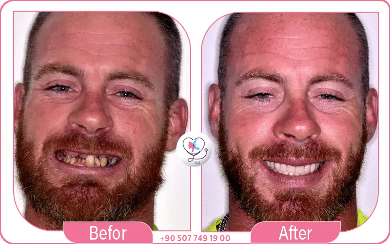 implant dentaire avant après