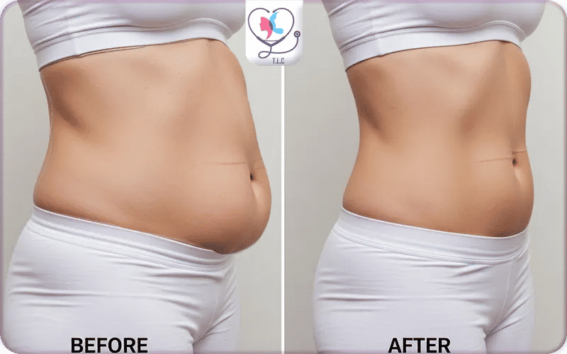 Abdominoplastie 1 an après