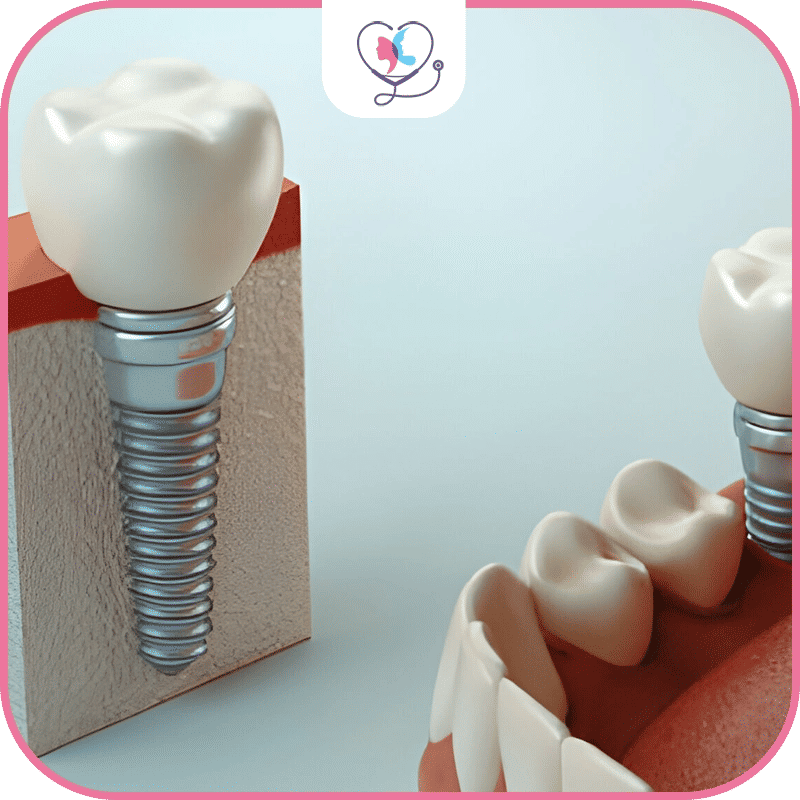 les-étapes-de-l’implant-all-on-6