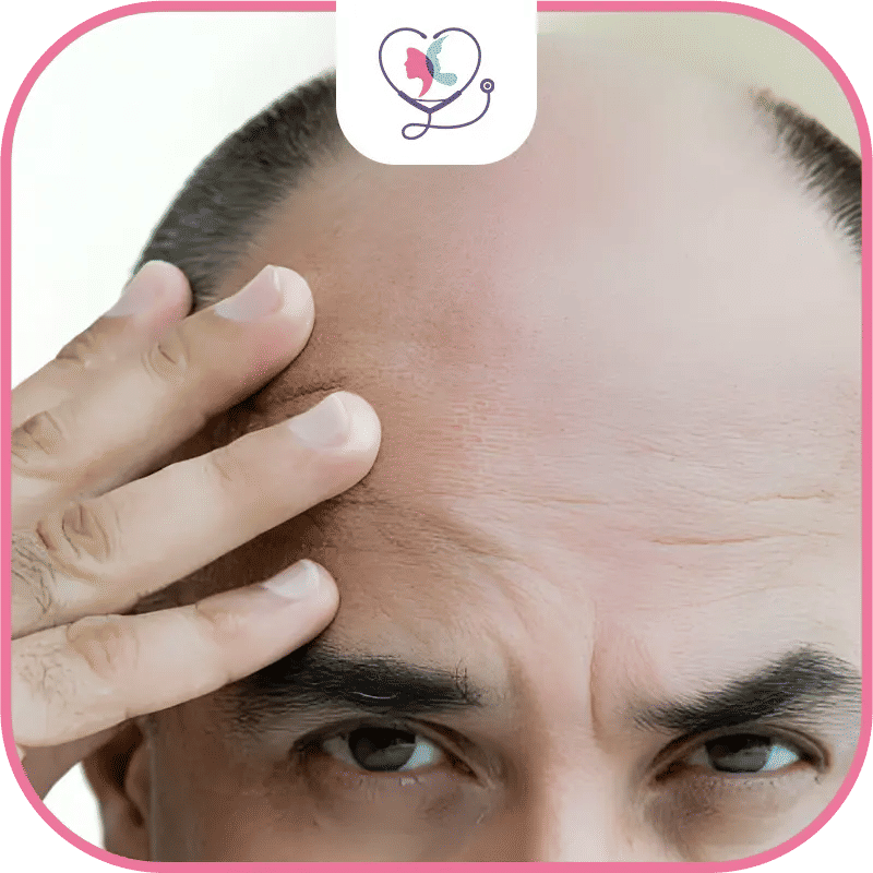 candidats-à-la-technique-perkutan-de-greffe-de-cheveux-?