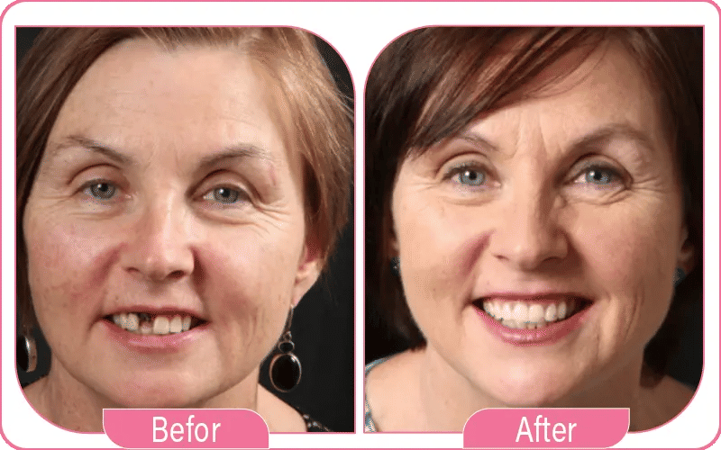 Single Tooth Implant in Turkey