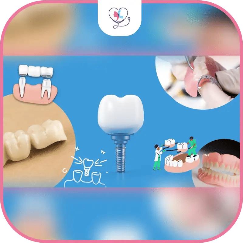 Dental Implant Alternatives: Bridges, Dentures & More image 1772043685237