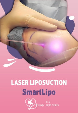 Laser Liposuction (SmartLipo): Results, Recovery & Areas