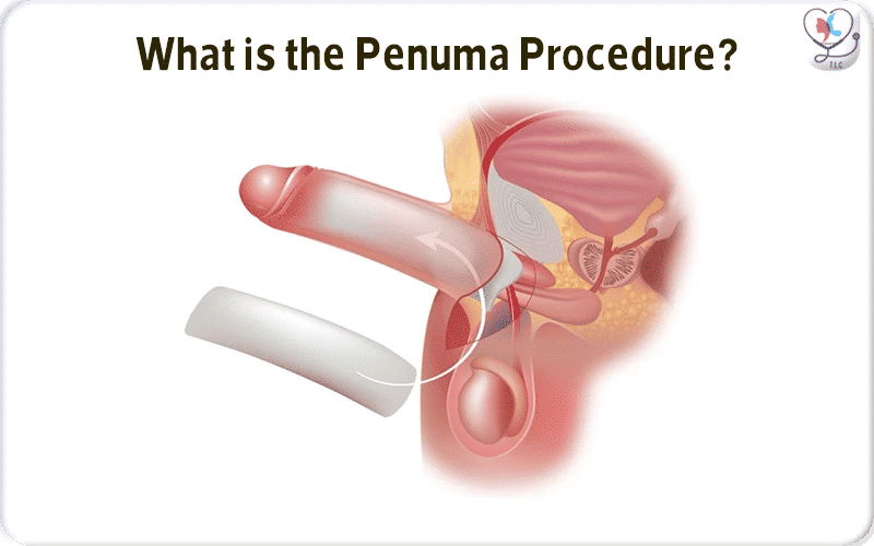 What is the Penuma Procedure?