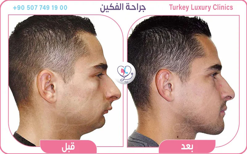 جراحة الفكين قبل وبعد