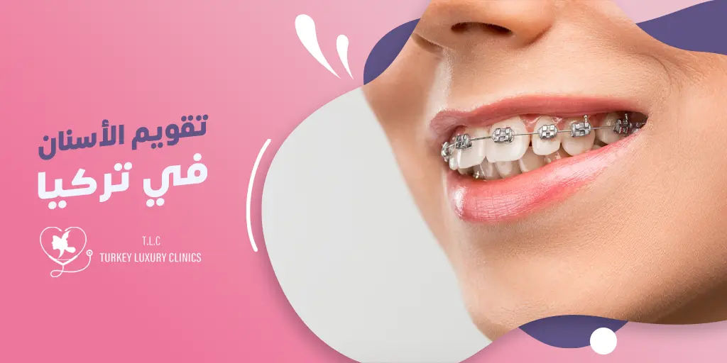 تقويم الأسنان في تركيا