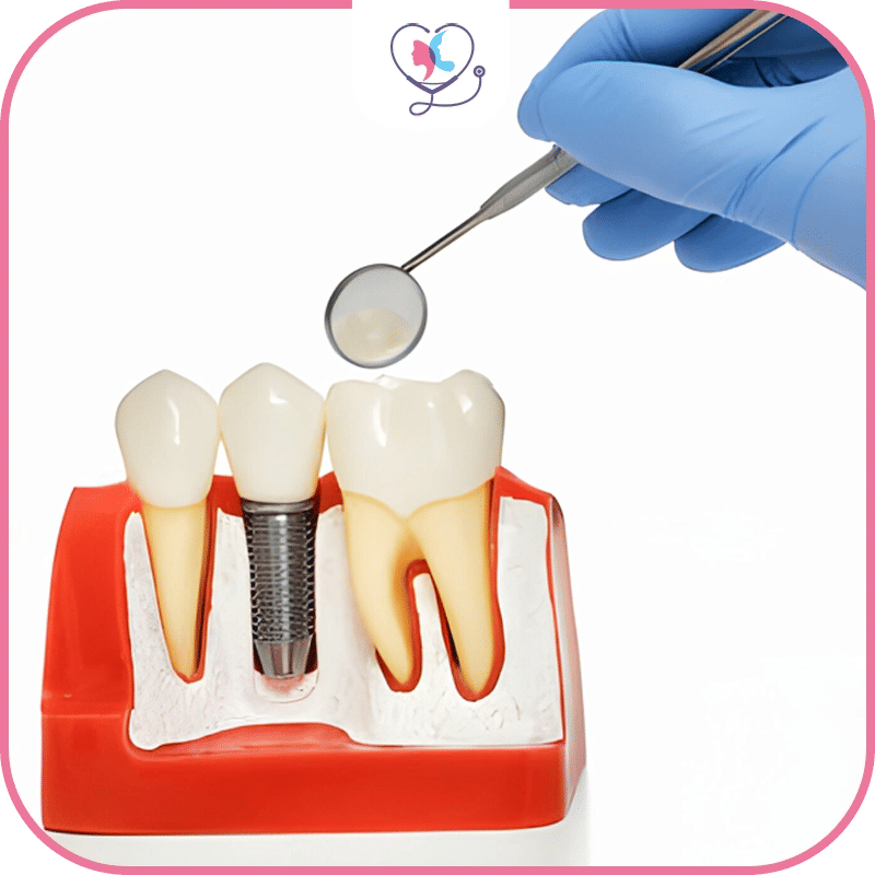 Les bridges dentaires