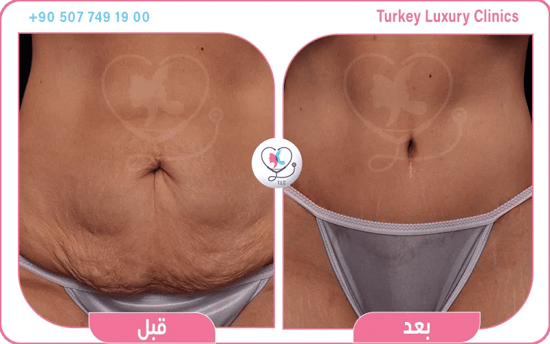 عملية شد البطن