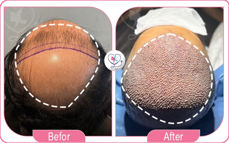 أولاً: الفريق الطبيُّ المتخصّص بزراعة الشّعر