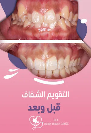 التقويم الشفاف قبل وبعد: صور حقيقية لنتائج مذهلة